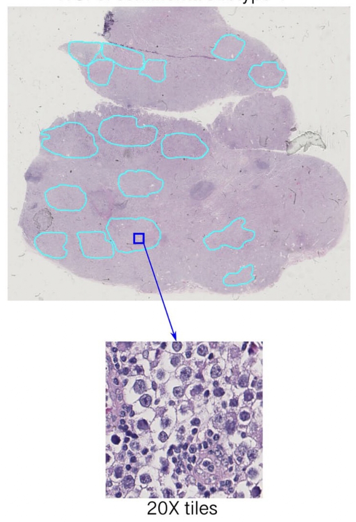Deep Learning for Subtypes Identification of Pure Seminoma of the Testis